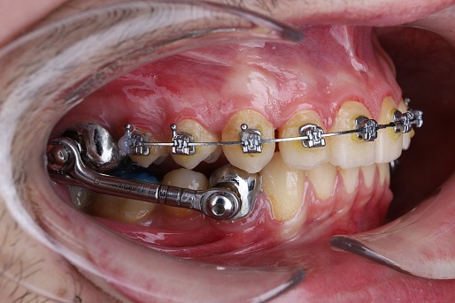 Лечение съемными ортодонтическими аппаратами
